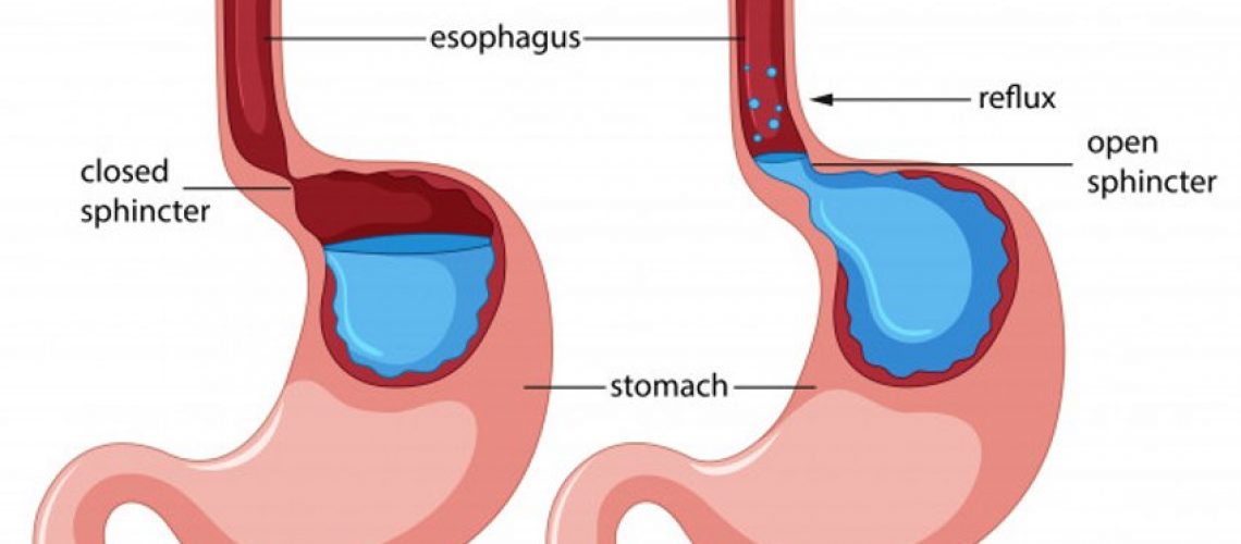 reflusso-gastro-esofageo